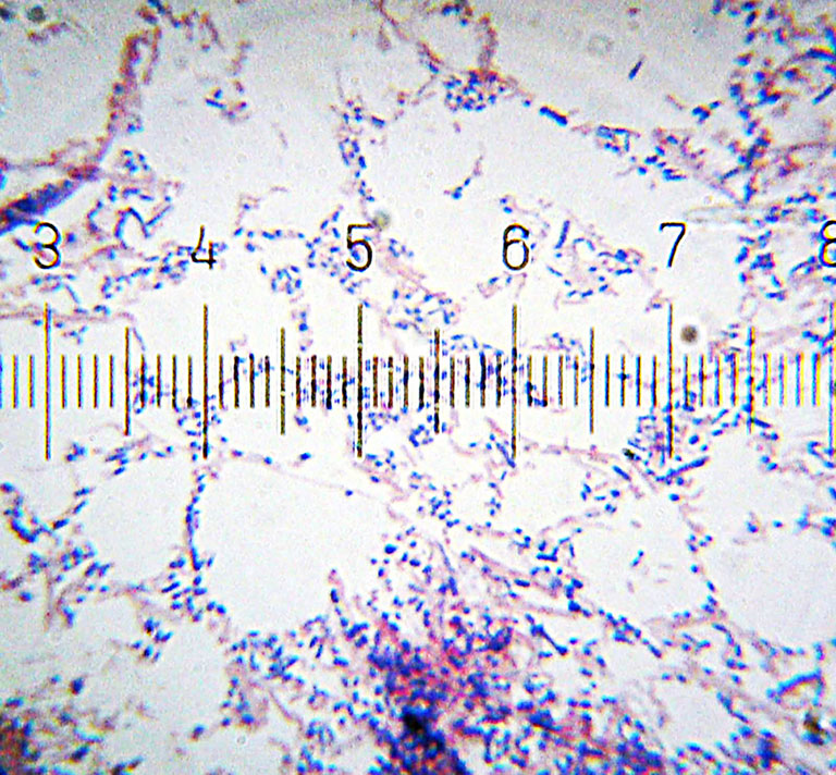 A microscope view of dental plaque that has been stained to show two categories of bacteria: Gram positive (purple) and Gram negative (pink).