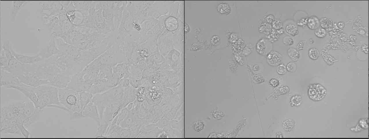 A snapshot of ovarian cancer cells at 0hr (left) and 12hours (right) treated with MicroQuin's small molecule drug. Cancer cells are dead and floating.