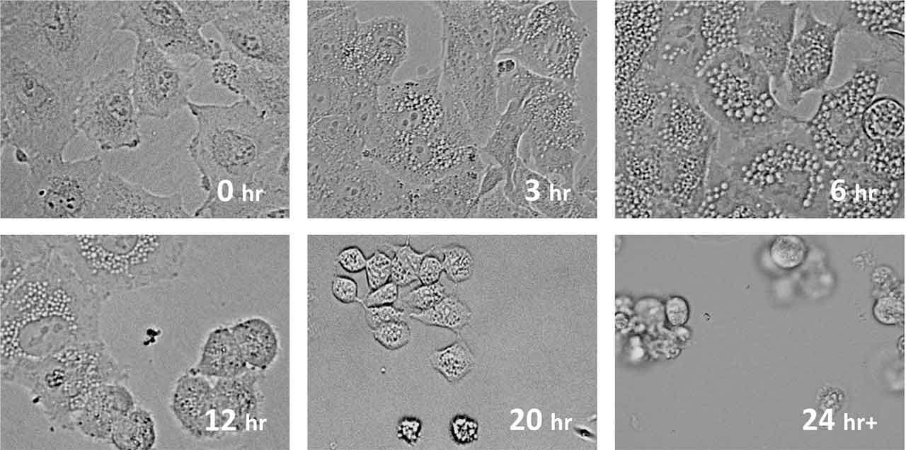 This 24-hour time progression of lung cancer cells treated with MicroQuin's small molecule drug shows holes forming in the endoplasmic reticulum (ER vacuolation) of the cells, with floating dead cancer cells in the final frame.